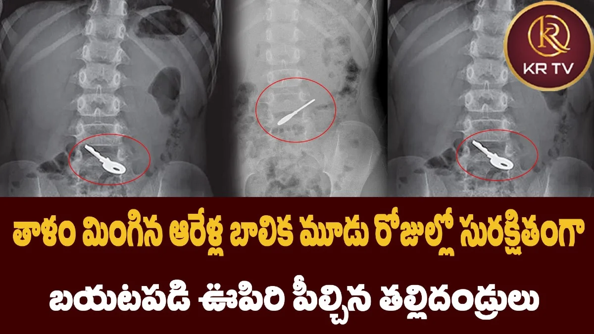 తాళం మింగిన ఆరేళ్ల బాలిక – మూడు రోజుల్లో సురక్షితంగా బయటపడి ఊపిరి పీల్చిన తల్లిదండ్రులు