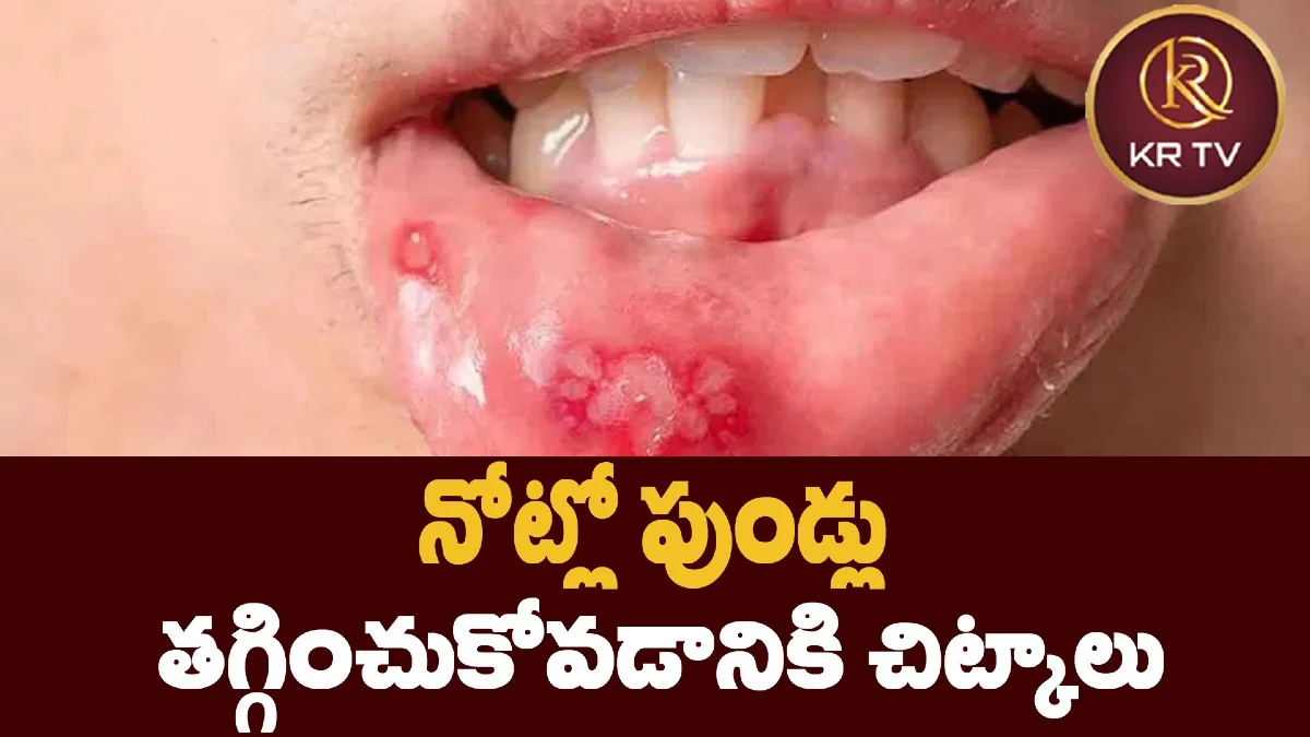 నోట్లో పుండ్లు తగ్గించుకోవడానికి చిట్కాలు