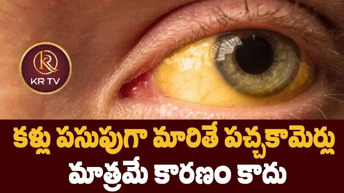 కళ్లు పసుపుగా మారితే పచ్చకామెర్లు మాత్రమే కారణం కాదు